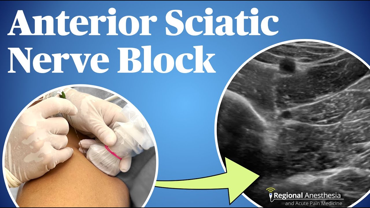 Ultrasound-Guided Anterior Sciatic Nerve Block - YouTube