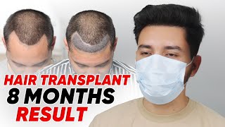 Hair Transplant in Almora | Best Results & Cost of Hair Transplant in Almora