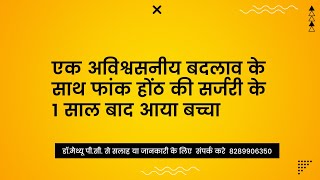 एक अविश्वसनीय बदलाव के साथ फांक होंठ की सर्जरी के 1 साल बाद आया बच्चा - Cleft Lip Surgery In India