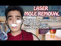 Mole Laser Removal 2024 | Magkano magpatanggal ng nunal| Masakit ba?