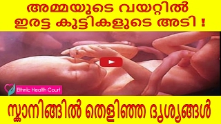 അമ്മയുടെ വയറ്റില്‍ ഇരട്ട കുട്ടികളുടെ അടി ! എം ആര്‍ ഐ സ്കാനിങ്ങില്‍ തെളിഞ്ഞ ദൃശ്യങ്ങള്‍