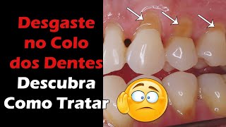 Abfração Dentária - Descubra o Que Causa e qual o Tratamento Para o Desgaste no Colo dos Dentes