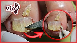 NAIL INFECTION SOLUTION  (OVERGROWN INFECTED INGROWN TOENAIL REMOVAL)