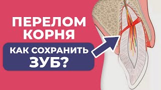 Что делать, если сломан корень зуба? / Первая помощь!