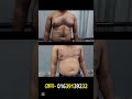 ছেলেদের বড় স্তন ছোট করার চিকিৎসা gynecomastia treatment in bangladesh