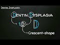 Mnemonic: Dentin Dysplasia Type I vs II | Oral Pathology Mnemonics