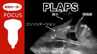 PLAPS【POCUS・肺超音波】