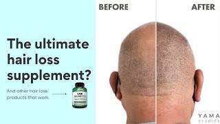 Which Hair Loss Products Actually Work? A Hair Loss Coach Explains