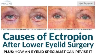 Causes of Ectropion after Lower Eyelid Surgery, and Possible Restoration by an Eyelid Specialist