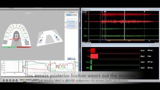 CHRONIC disk displacement WITHOUT REDUCTION-when NOT to DTR!