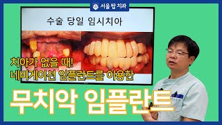 치아가 없어도 임플란트로 제2의 치아를 만들 수 있는 무치악임플란트