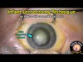 CataractCoach 1101: infant lensectomy for baby with congenital cataracts