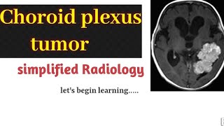 Unveiling the Secrets of Choroid Plexus Tumors 🧠✨ #radiology  #ChoroidPlexus #BrainTumorDiagnosis\