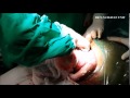 breech delivery in lscs dr. niranjan chavan 19