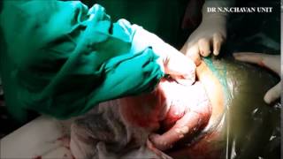 Breech Delivery in LSCS - Dr. Niranjan Chavan (19)