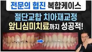 7년 전 교정했는데 교합이 불안정해요ㅠㅠ 예쁜 앞니 만들고 싶어요! 치아재교정+앞니심미보철+치아미백까지! 이게 다 가능하다고?! 전문의 협진 치과라 가능했습니다 🙋‍♂️