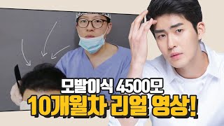 [모힐TV] 4500모 모발이식 10개월차, 이것이 Real이다!