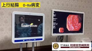 EndoBRAIN-EYE colonoscopy①