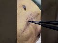 eyebrowplantingworkshop eyebrowplantingvideo 植眼睫毛課程 植眉毛教學 植睫毛 植发疤痕 植眉植发植眼睫毛植胡子 植发 植发效果