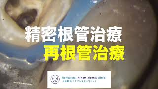 精密根管治療 　【愛知県刈谷市の歯医者】　再根管治療　One Visit Root Canal Therapy　オンライン診療　自由診療　顕微鏡歯科　マイクロスコープ　Kariya city