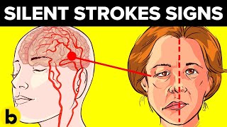 How To Treat A Stroke You Didn’t Even Know Happened
