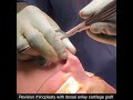 revision rhinoplasty by dr. anurag agarwal using a dorsal onlay graft