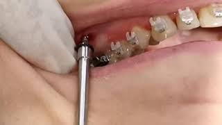 IZC screw, Infra Zygomatic Crest TAD, insertion of IZE mini screw, IZC orthodontic mini implant