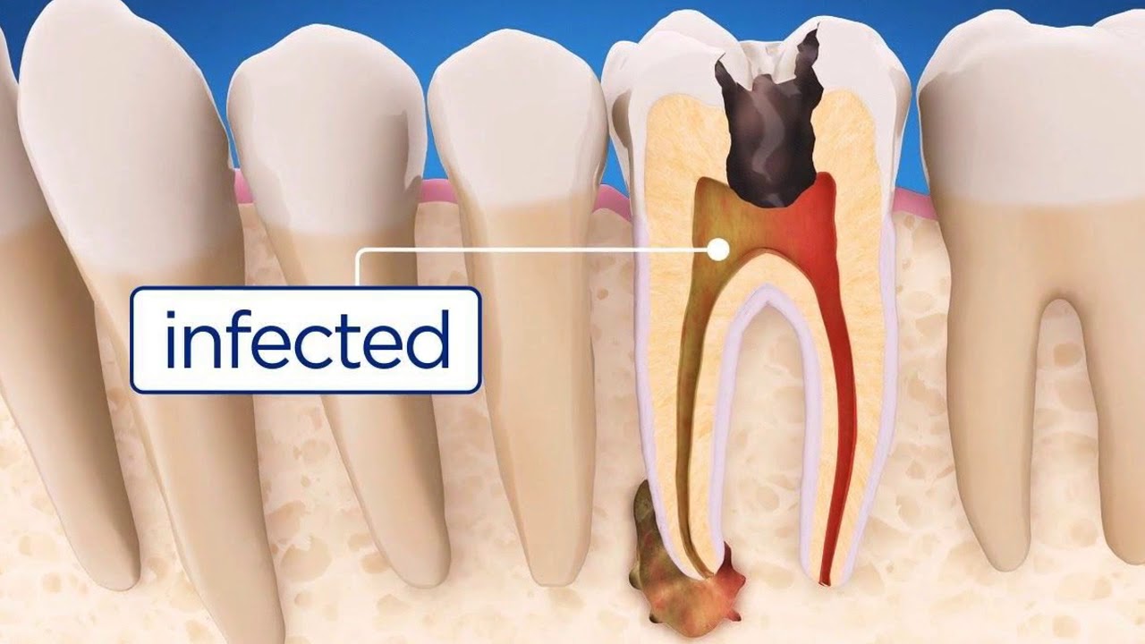 Root Canal Procedures And Guidelines - YouTube