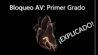 ECG: Bloqueo Auriculo-Ventricular de Primer Grado