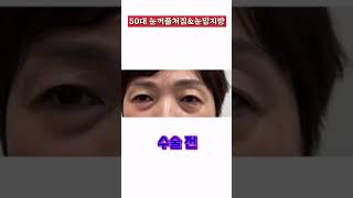 50대 눈꺼풀처짐 눈밑지방 수술로 어려보이는 눈매 완성 #눈썹거상 #눈밑지방재배치 *모든 시술/수술은 부작용이 있을 수 있습니다 #모즈클리닉