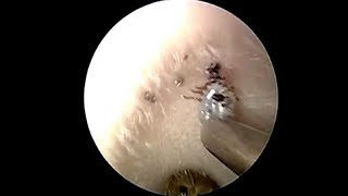 Shocking Moment Doctor Removes Live Tick From Ear Canal