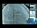 LIVE CASE 18  PDA closure with Coccoon duct occluder Metin Sungur, Abdullah Erdem