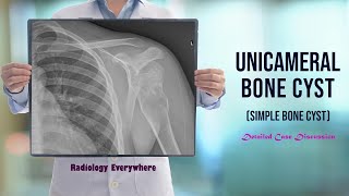 Unicameral Bone Cyst | Simple Bone Cyst | Radiology Tutorials | Radiology Everywhere