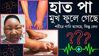 কি কারনে হাত,পা,মুখ ফুলে গেছে,হঠাৎ শরীরে পানি আসছে ||  ইডিমা  || Edema || @Bengalihealth101