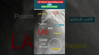 Distal Lad 100% blockage #angiography #heart #shorts