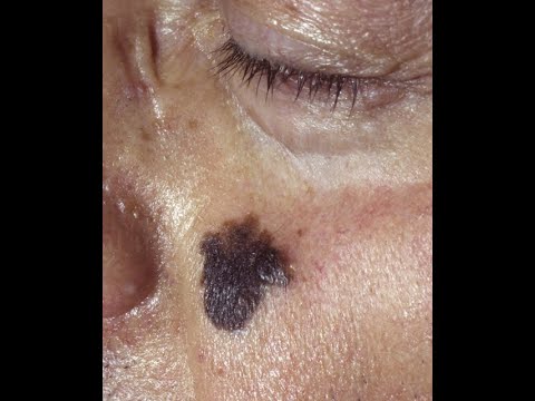 Can lentigo become cancerous?