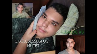 I.BÖLCSESSÉGFOG MŰTÉT/Fogvlog #3