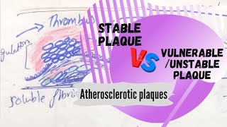 Stable Plaque VS Vulnerable/Unstable Plaque | Atherosclerotic plaques.