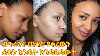 በሳምንት ውስጥ ብጉር እና የጠቆረውን እንዴት እንዳስለቀኩት how to get red of pimples