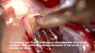 Combined interhemispheric translamina terminalis \u0026 pterional approach for a dorsum sellae meningioma