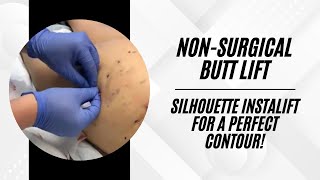 Non-Surgical Buttock Lift with Threads | Silhouette InstaLift | Live