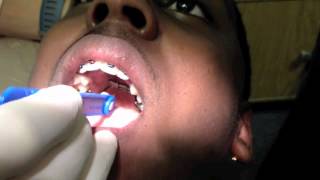 Rapid Palatal Expansion instructions