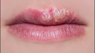 How To Get Rid Of Coldsores Fast