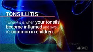 The Basics: Tonsillitis | WebMD