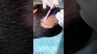 Alopecia Areata Treatment For Hair Growth | Treatment Of Alopecia | Skinaa Clini