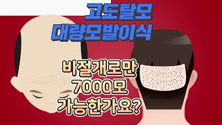 대량모발이식 비절개로만 7000모 8000모 가능한지 루트에 물어 보았습니다.