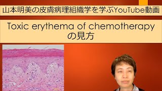 山本明美の皮膚病理解説動画　Toxic erythema of chemotherapyの組織像