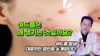 여드름은 사춘기에 심해지지만 다양한 원인으로 발생하게 됩니다.