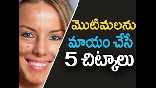 Pimples removal on face at home in telugu | How to remove pimples | How to get rid of pimples fast