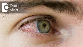 What causes a red spot  in sclera & how to  get rid of it? - Dr. Elankumaran P